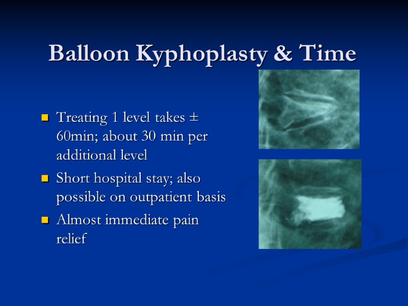 Balloon Kyphoplasty & Time Treating 1 level takes ± 60min; about 30 min per